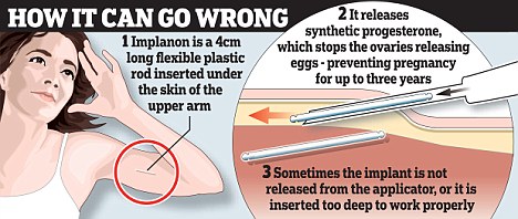 How the implant can go wrong